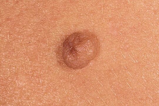 Papilloma sinxelo