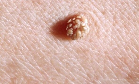 Papiloma no corpo humano